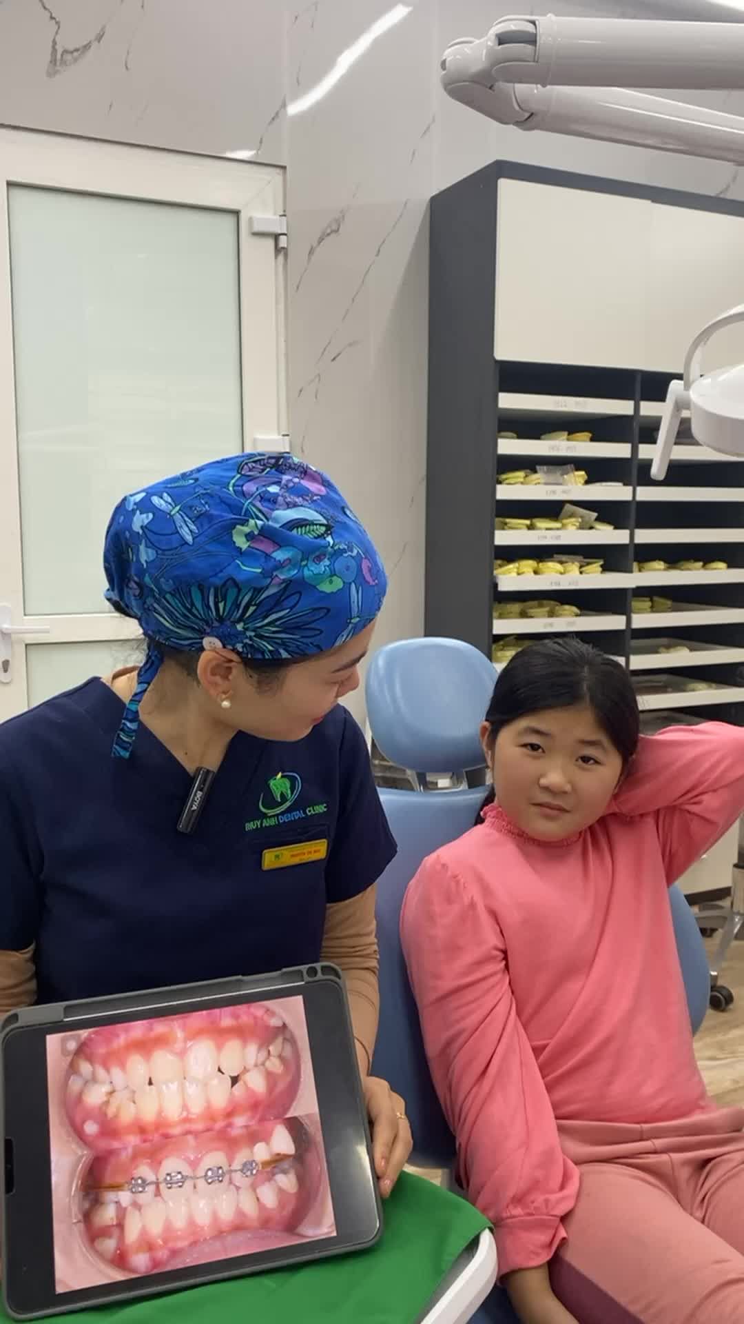 Kết quả như ý sau tháo mắc cài cho bạn khách hàng gặp tình trạng khớp cắn ngược vùng răng cửa