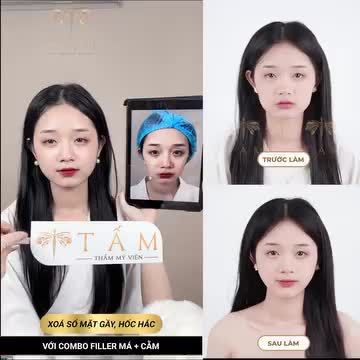 Má hóp, cằm lẹm sẽ thay đổi như thế nào sau khi sử dụng dịch vụ FILLER?