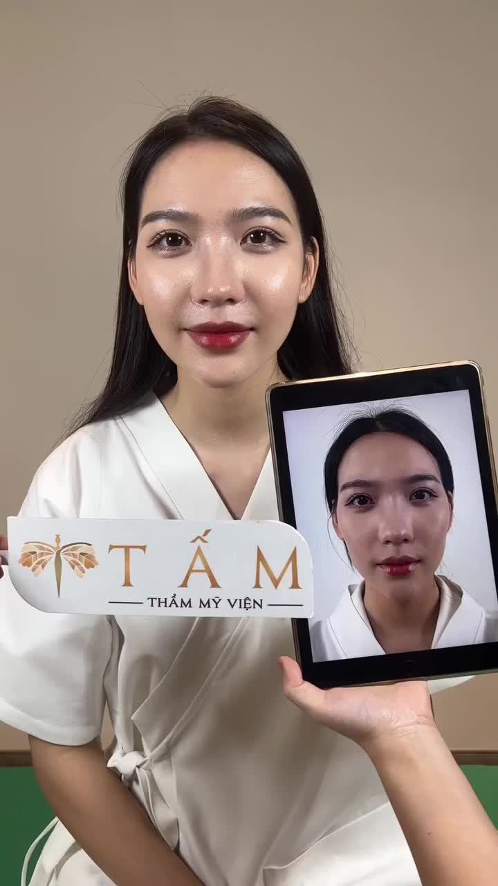 HIỆU QUẢ SAU KHI CĂNG CHỈNH FILLER THÁI DƯƠNG - MÁ