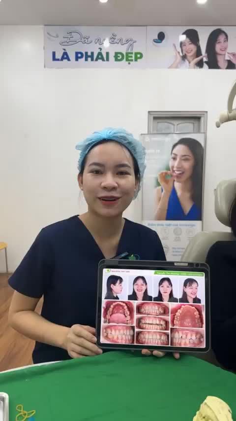 Gắn mắc cài niềng răng điều trị khớp cắn đối đầu cho chị khách hàng tại Nha Khoa Thuỳ Anh