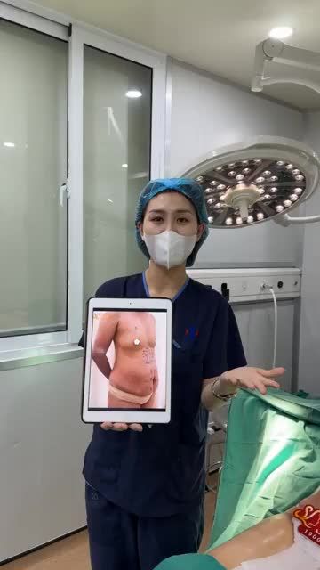 Kết quả ca hút mỡ siết eo 360 độ và nâng cấp vòng 1 hôm nay