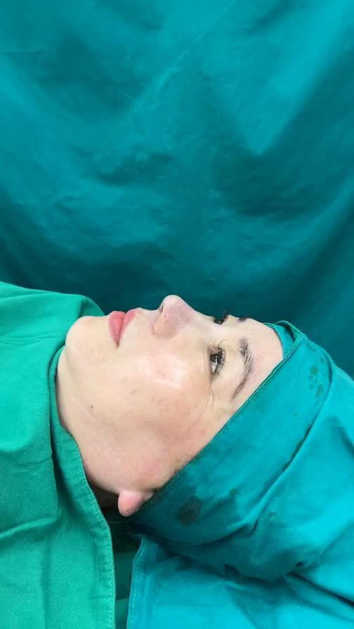 Case mũi cấu trúc vừa hoàn thành cho chị gái đến từ Đồng Nai!!
