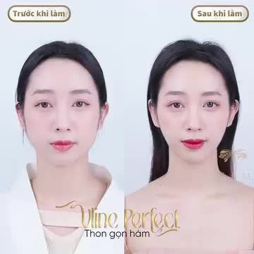 CHỊ KHÁCH HÀNG HÓA “THẦN TIÊN TỈ TỈ” SAU KHI THON GỌN HÀM BẰNG CÔNG NGHỆ CAO VLINE PERFECT TẠI TẤM