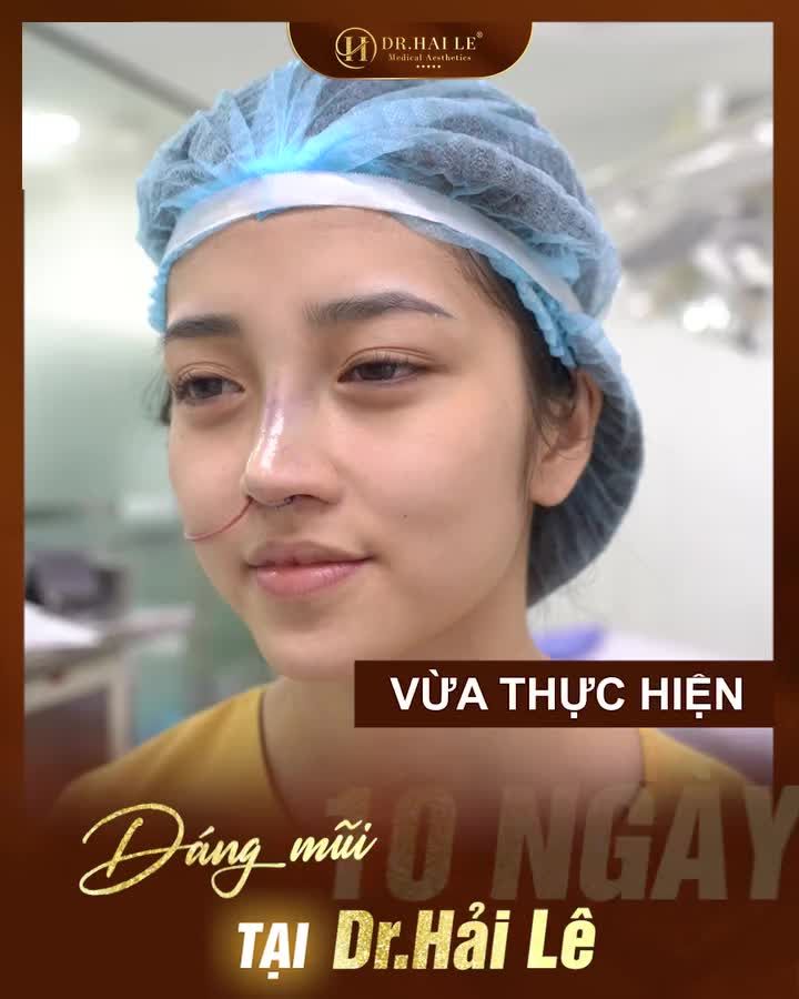 Dr.Hải Lê tiên phong trong kỹ thuật nâng mũi, đón đầu xu hướng mới, giúp hàng trăm ngàn khách hàng sở hữu dáng mũi cao bay, đẹp sang không sến!