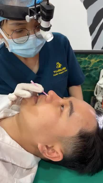 Mũi cấu trúc sau 2 tháng sẽ như thế nào??
