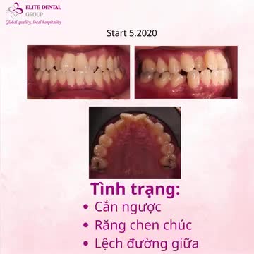 NIỀNG RĂNG TRONG SUỐT GIẢI QUYẾT CẮN NGƯỢC, RĂNG CHEN CHÚC