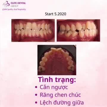 NIỀNG RĂNG TRONG SUỐT GIẢI QUYẾT CẮN NGƯỢC, RĂNG CHEN CHÚC