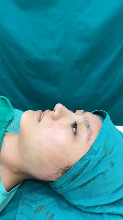 Mũi cấu trúc 29TR500 - Vừa hoàn thành sau 90 phút - Dáng mũi cao tây tự nhiên, hợp mặt, hợp phong thủy.