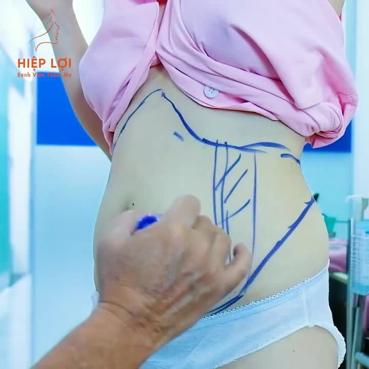 Với công nghệ kỹ thuật cao, Bệnh viện Hiệp Lợi hiện đang áp dụng một số phương pháp hút mỡ công nghệ cao bằng "TIA NƯỚC" mang lại hiệu quả an toàn, rõ rệt.
