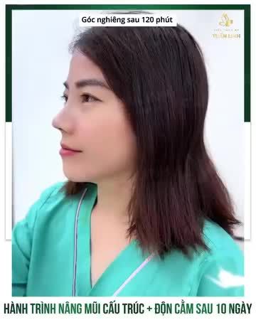 HÀNH TRÌNH 10 NGÀY NÂNG MŨI CẤU TRÚC + ĐỘN CẰM