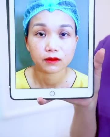 7 ngày sửa mí - Đôi mắt đẹp như ý!