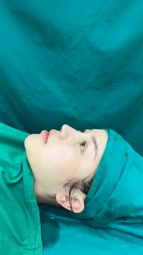 Case mũi tái cấu trúc phức tạp ( mũi sửa lại nhiều) cho bạn gái đến từ Nghệ An!!