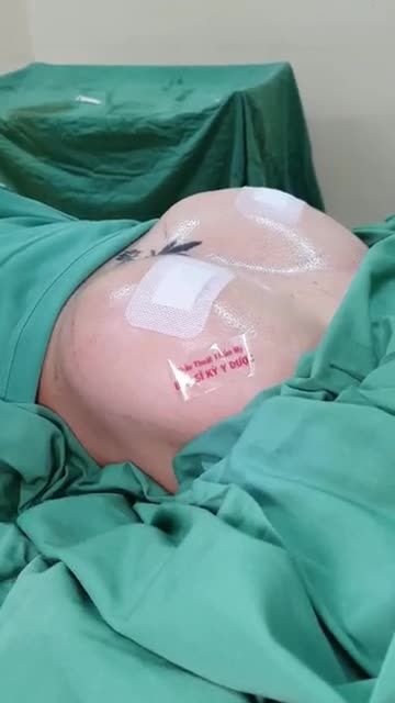 Chỉ có thể là NÂNG NGỰC NỘI SOI tại bác sĩ Kỳ Y Dược