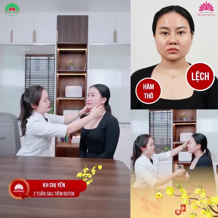 CĂN CHỈNH MẶT CHUẨN VLINE VỚI BOTOX CHÍNH HÃNG