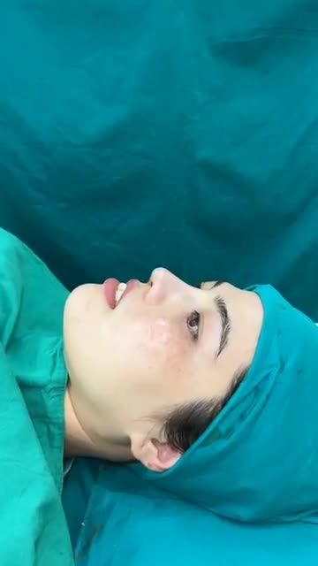 Case mũi cấu trúc Surgiform vừa hoàn thành!!