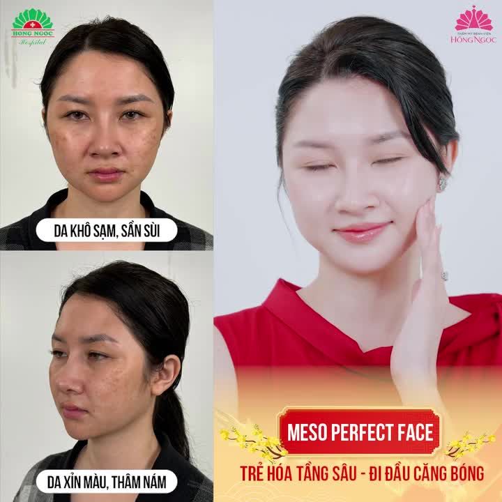 HẬU THỰC HIỆN MESO, MẸ BỈM SỞ HỮU VẺ ĐẸP KHÔNG TUỔI