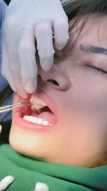 QUÁ TRÌNH THẨM MỸ 18 RĂNG SỨ E.MAX CHO MỘT NỮ KHÁCH HÀNG