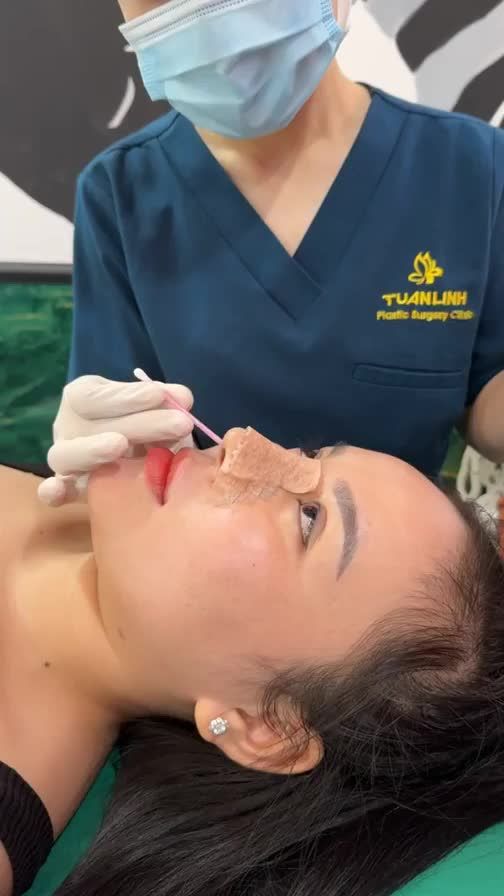 Mũi bọc sụn sau 10 ngày