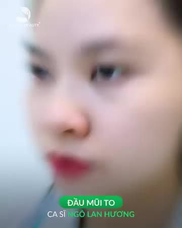 Nâng mũi ca sĩ Ngô Lan Hương