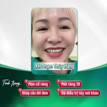 CHIA SẺ CỦA NỮ KHÁCH HÀNG XNH ĐẸP TÁI KHÁM SAU 1 NĂM THẨM MỸ RĂNG SỨ