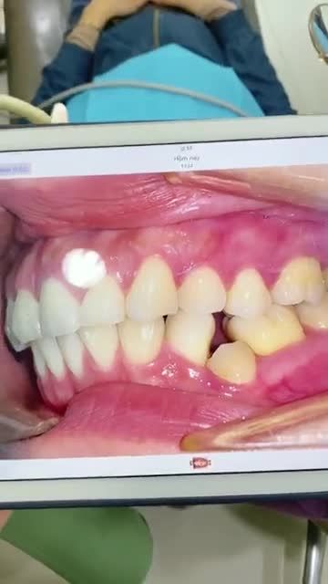 XUẤT SẮC: Với KẾT QUẢ Niềng răng + Phẫu thuật hàm hô cho Chị gái U30 tại JW