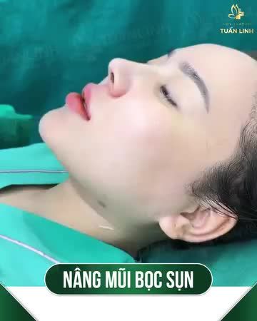 Nâng mũi bọc sụn - Kiến tạo góc nghiêng "thần thánh" chỉ sau 60 phút