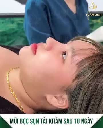 MŨI BỌC SỤN VÀO FORM XINH XỈU SAU 10 NGÀY TÁI KHÁM!!
