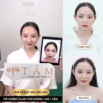 MÊ MẨN KẾT QUẢ LÀM FILLER KHÔNG SƯNG, KHÔNG ĐAU, ĐẸP CUỐN HÚT TẠI TMV TẤM