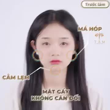 Thay đổi để đẹp hơn chỉ mất 30p với filler má - cằm tại Tấm !