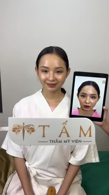 Ca cân chỉnh khuôn mặt bằng Filler