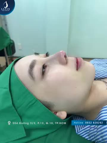 Dáng mũi cao tây cho em gái từ Nhật về Việt Nam làm đẹp
