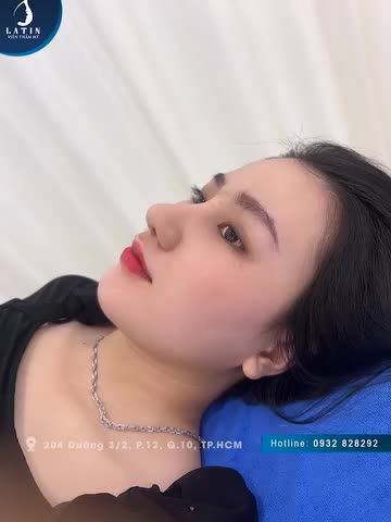 XINH NHƯ HOT GIRL SAU 12 NGÀY NÂNG MŨI LATIN