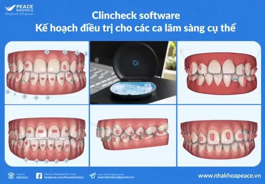 CHỈ CÓ INVISALIGN CUNG CẤP ĐƯỢC 1 CLINCHECK TỐT NHẤT, CHÍNH XÁC NHẤT VỚI CÁC CÔNG NGHỆ ĐỘC QUYỀN TỪ MỸ