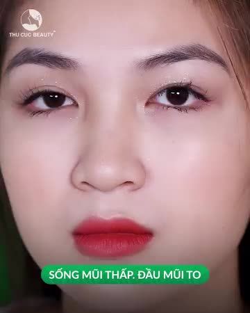 Nâng mũi Thu Cúc mềm mại, cao bay, đẹp tự nhiên