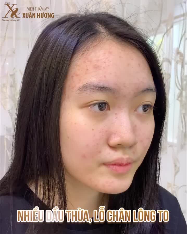 KHI “MỤN” LÀ NỖI ÁM ẢNH, LÀM BẠN THIẾU TỰ TIN !!!