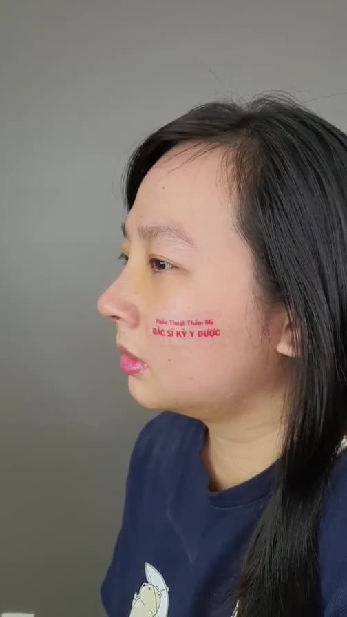 Combo Nâng Mũi Aline + Độn cằm sau 6 ngày