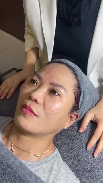 TIÊM MESO TRỊ MỤN thay da em bé LÁNG MỊN cho quý cô U50