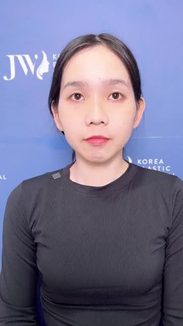 CHIÊM NGƯỠNG kết quả phẫu thuật CẮT HÀM HÔ cho NỮ 9X thoát cảnh MẶT LỆCH hết hô VĨNH VIỄN
