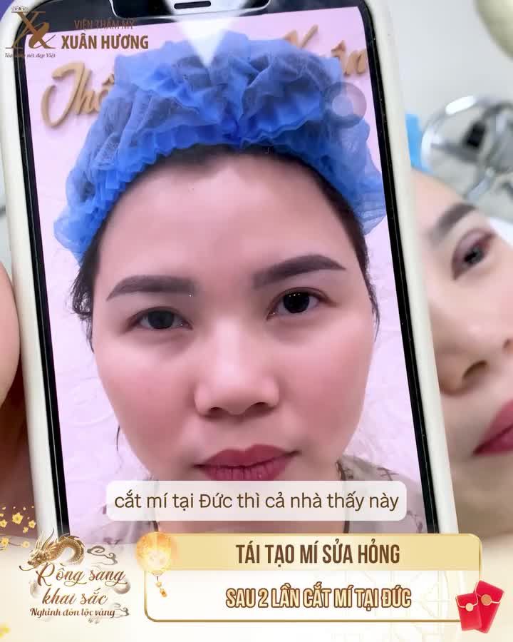 Tranh thủ dịp Tết về Việt Nam, nữ Việt kiều Đức ghé VTM Xuân Hương sửa ngay mí cắt hỏng 2 lần tai Đức.