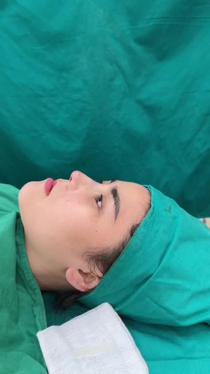 Case mũi cấu trúc sửa lại sau hơn một năm nâng mũi thường ở nơi khác!!