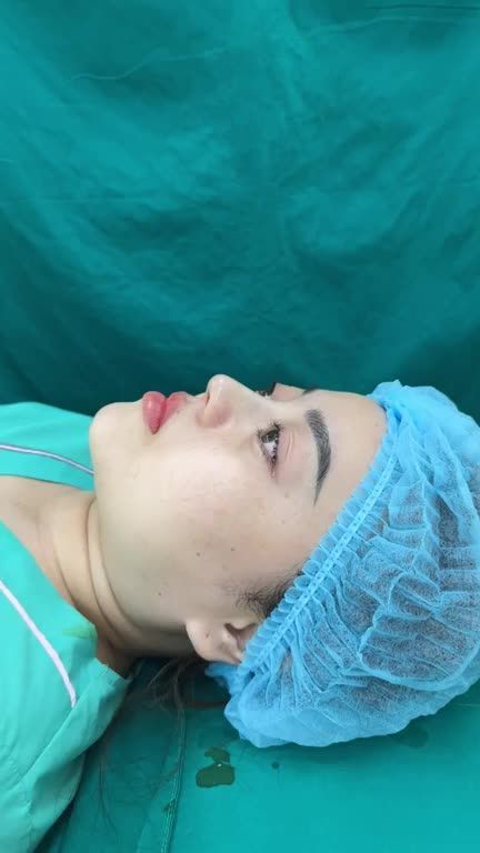 Case nâng mũi bọc sụn cho bạn gái gò vấp thích dáng mũi tự nhiên!!