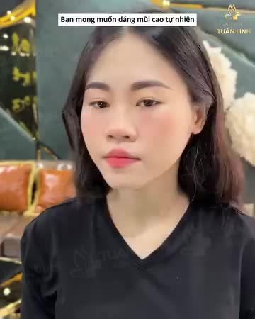 Nâng mũi bọc sụn sau 60 phút - Giá trọn gói chỉ 15TR