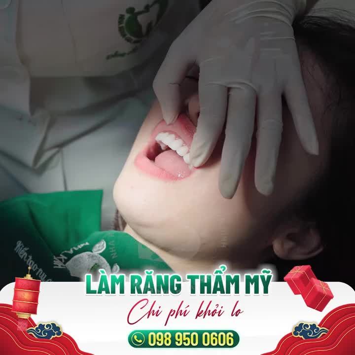 THẨM MỸ RĂNG SỨ TẠI NHA KHOA GIA ĐÌNH BẢO TỒN RĂNG THẬT, KHÔNG MÀI NHỎ RĂNG