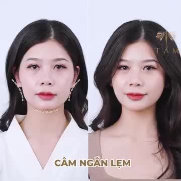 XOÁ SỔ MÁ HÓP, CẰM NGẮN LẸM VỚI COMBO FILLER TẠI TMV TẤM