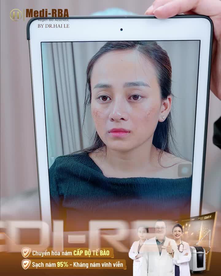 Trước khi đến Dr.Hải Lê: làn da của chị Thu Giang không những gặp phải tình trạng nám nghiêm trọng mà còn bị bong tróc, tổn thương nặng do sử dụng kem trộn.
