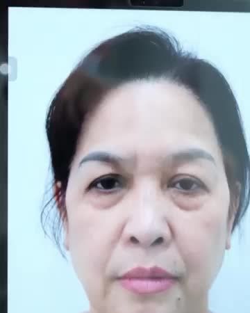 Kết quả sau 1 tháng thực hiện combo: Nâng cung mày, cắt cơ cau mày, cắt và trẻ hóa mí dưới.