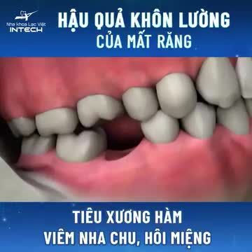 CẢNH BÁO HẬU QUẢ KHÔN LƯỜNG KHI MẤT RĂNG VÀ PHƯƠNG PHÁP KHÔI PHỤC RĂNG MẤT HIỆU QUẢ NHẤT