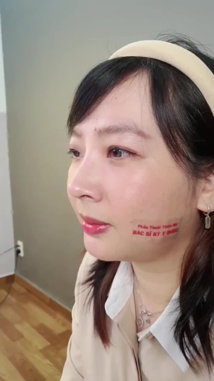 Nâng mũi ALINE Trong tháng 3 - giá chỉ từ 11tr.