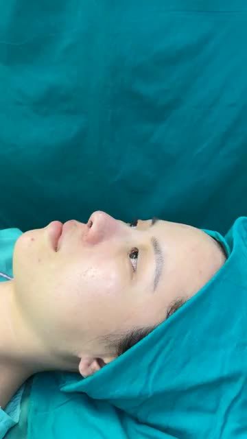 Case mũi cấu trúc thứ 3 trong buổi sáng vừa hoàn thành tại Tuấn Linh!!