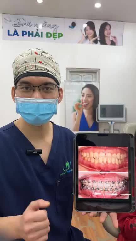 Phân tích kết quả thay đổi sau thời gian chỉnh nha khắc phục tình trạng khớp cắn ngược, lệch khớp cắn cho chị khách hàng tại nha khoa Thuỳ Anh.
